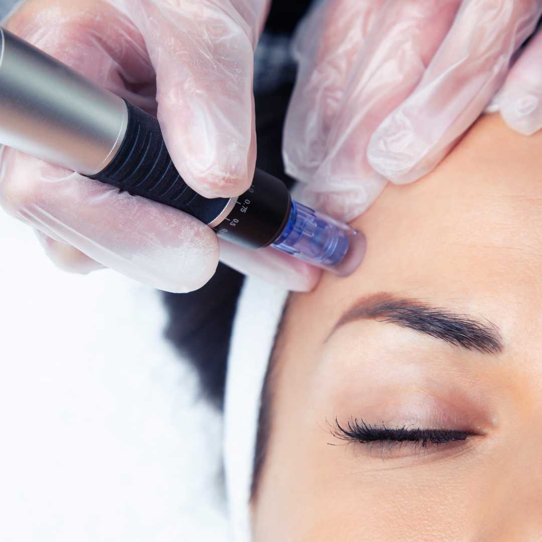 Microneedling Dresden